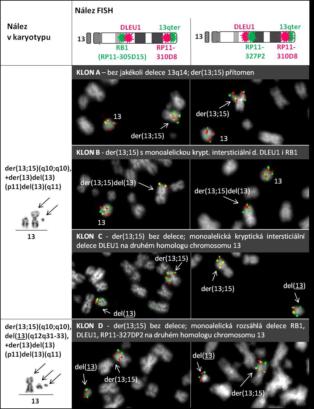 Obrázek 4.6 Multiklonální intersticiální delece 13q14 vyšetření karyotypu a kombinované FISH vyšetření se sondami pro DLEU1 a RP11-305D15 a DLEU1 a RP11-327P2 Vyšetření u pacienta č. 222.