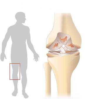 1.6.1 Gonartróza Gonartróza (obr. 7) je osteoartróza kolenních kloubů. Její rozvoj je často velmi pozvolný. Potíţe s pohybem, bolest a kloubní změny se objevují postupně v průběhu několika let.