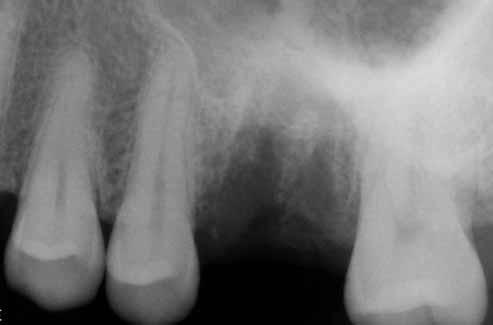 Pacient byl odeslán na implantologickou konzultaci. Pacient požadoval náhradu chybějícího zubu fixní náhradou nesenou implantátem tak, aby nezahrnovala sousední zuby.