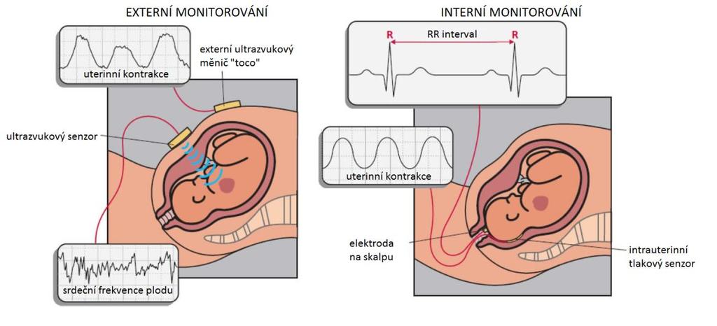 interní monitorování KTG, při kterém jsou elektrody přiloženy přímo na hlavičce plodu. Toto měření je však možné provést až v době před porodem, kdy jsou protrženy membrány.