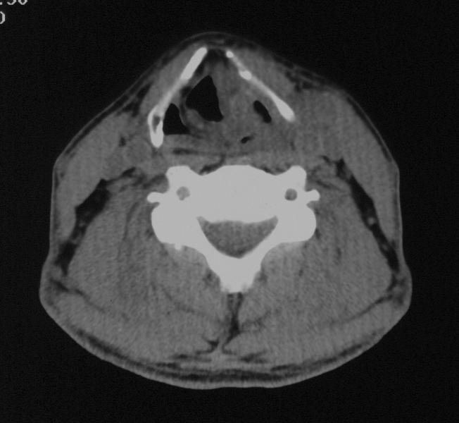 V. Larynx CT (zobrazení glottis a supraglotické části laryngu 2-3 mm scany) MR (výhodou možnost