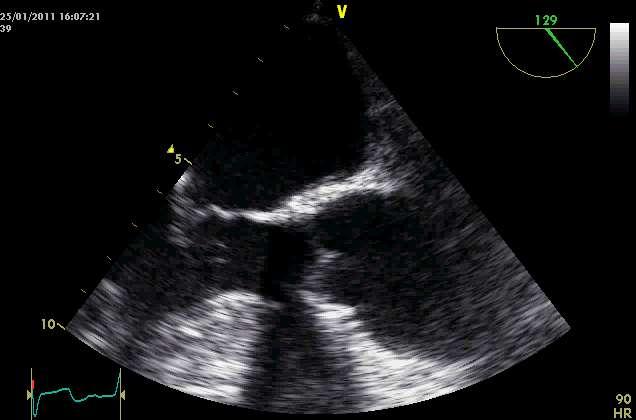 heart failure Initial negative fluid