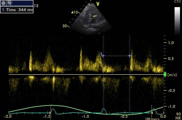 systolic dysfunction Time in which