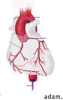 1. Čo je katetrizácia srdca, koronárna angiografia?