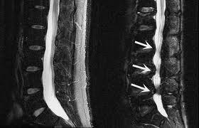 Stenózy páteřního kanálu nejčastěji bez prolapsu disku symptomatologie dle výšky léze a místa komprese míchy (retikulospinální trakt vs. zadní funiculus ) až 50% pac.