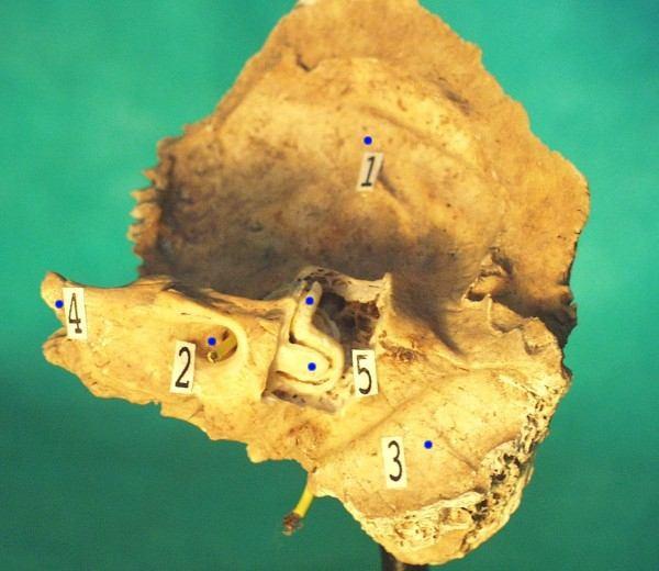 Os temporale labyrinthus osseus 1-squama 2-porus acusticus int. n.