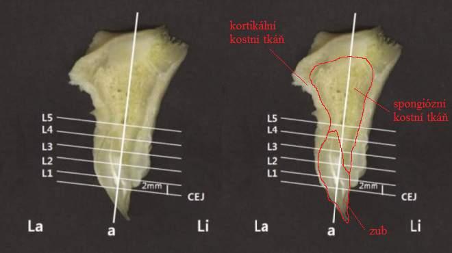 24 1 Anatomie dutiny ústní Tloušťka kortikální kostní tkáně Tloušťka kortikální kostní tkáně je důležitá pro stabilitu zaváděného implantátu.