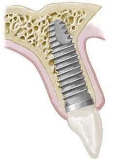 32 2 Dentální implantologie 2.