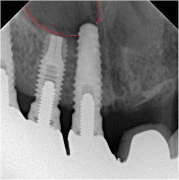 2.5 Úskalí implantace do horní čelisti 33 V současné době se nejčastěji používá klasifikace úspěšnosti zavedení podle Albrektssona, a pokud implantát splňuje následující kritéria, lze považovat