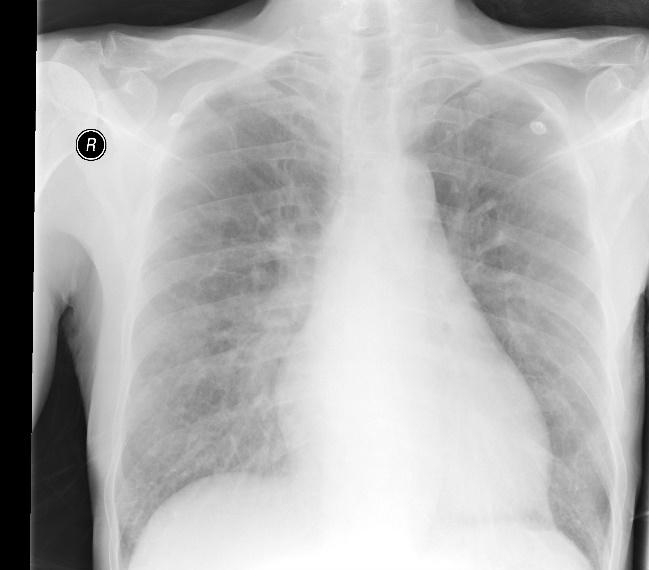 10mmHg Ergometrie zajištění interpretace EKG, obtíží pacienta pomůcky k zajištění iv.