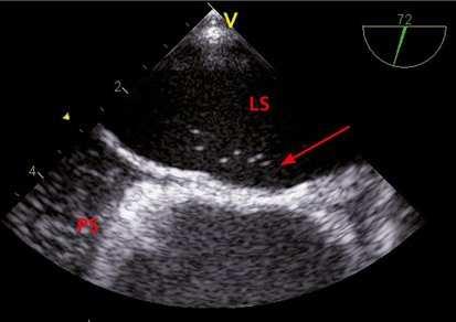 Echokardiografie Echokardiografie - modality neinvazivní vyšetřovací metoda využívající ke zobrazení srdečních struktur ultrazvukové vlnění princip metody spočívá ve vysílání ultrazvukových