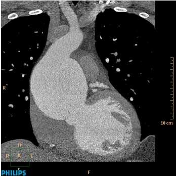 relativní CT srdce a CT koronarografie kontraindikace nespolupracující pacient ( 20s apnoe) chronická renální