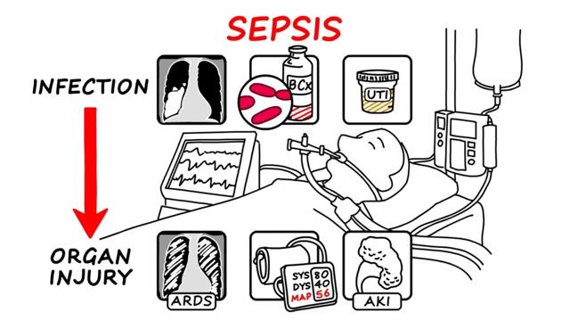 SEPSIS III klinická kritéria Infekce Orgánová dysfunkce Orgánová dysfunkce akutní změna v hodnotě SOFA skóre 2