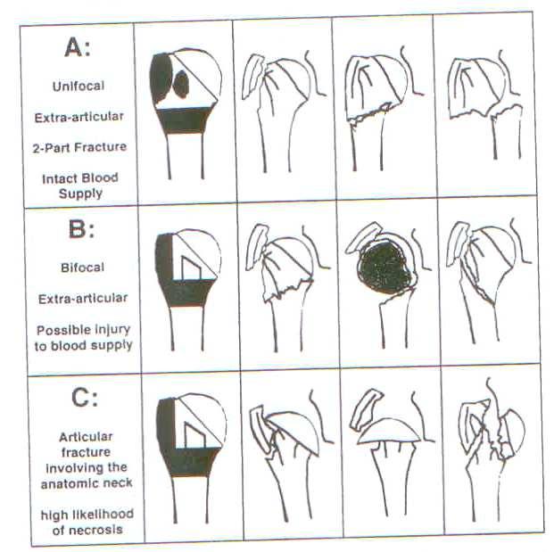 Obr. č. 6 - AO klasifikace (1) Typ A tvoří extraartikulární, jednohnisková (unifokální) zlomenina s neporušeným cévním zásobením.