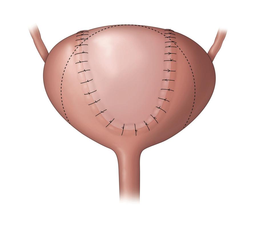 časť čreva všitá do močového mechúra na zvýšenie jeho kapacity pôvodná veľkosť močového mechúra Obr. 4: Operačný zákrok na zvýšenie kapacity močového mechúra.
