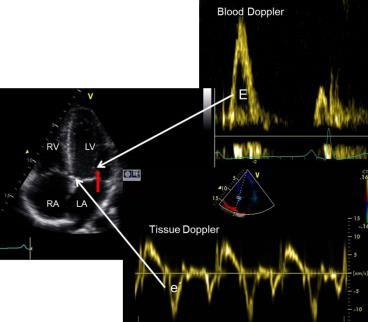 E:A >1; DT < 200ms PW TDE tkáňová dopplerovská echokardiografie (analýza signálů o nízké rychlosti a vysoké amplitudě) Zachycuje pohyb