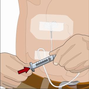 Před zahájením infuze zkontrolujte správné umístění jehly, pokud Vás o tom zdravotník poučil. 13.
