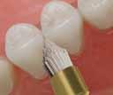 Patentovaný systém upevnění se zapuštěným mandrelem umožňuje přesnou práci a chrání sousední zuby a tkáně před poškozením. 1 SADA OptiDisc General KE4200 2.