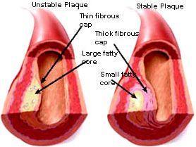 Nestabilní aterosklerotické pláty nestabilní pláty: heterogenní s
