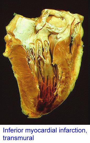 Ischemická choroba srdeční Ischemií myokardu nazýváme stav, kdy není zajištěn dostatečný přívod kyslíku do tkáně a nejsou dostatečně