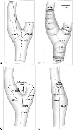 Variabilita geometrie bifurkace karotid dle MR rekonstrukce Zdraví