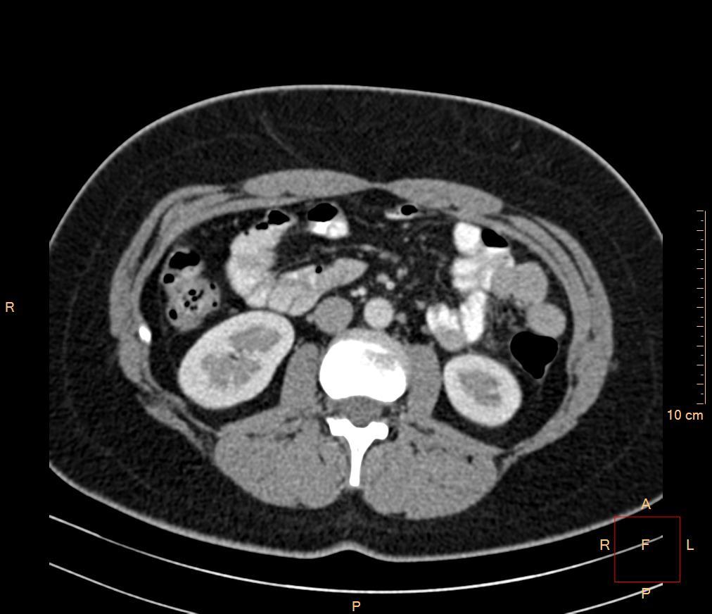 M.psoas major Tenké kličky Colon descendens Colon ascendens