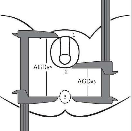 AGD AS Mean 51.3 ± 14.5 mm AGD AS: center of anus to posterior base of the scrotum (point 2 to 3).