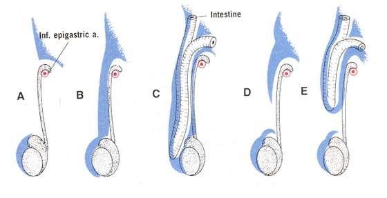 Retentio testis,