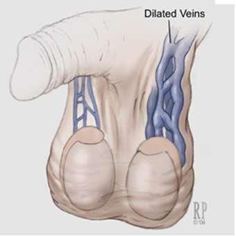 Varikokéla varikozity testikulárních žil,