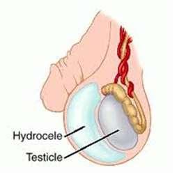 spermiogeneze a fertility Hydrokéla