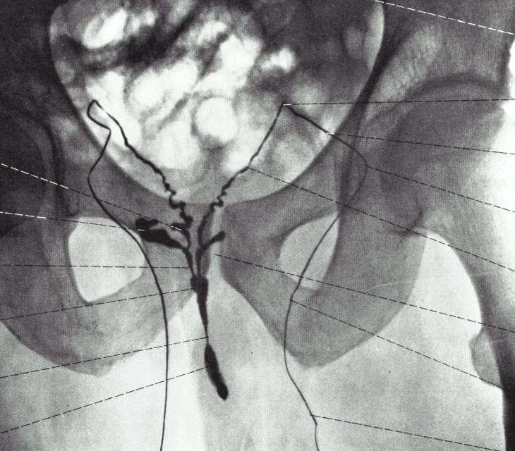 Ductus deferens: pars scrotalis, pars funicularis, pars inguinalis, pars