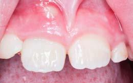 110 ODBORNÉ SDĚLENÍ Obr. 5: Klinický stav 2 týdny po ošetření maturogenezí. Na fotografii je viditelný submukózní absces v oblasti zubu 11. Obr. 5 Obr.