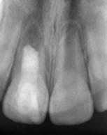 112 ODBORNÉ SDĚLENÍ Obr. 11: Rentgenový snímek 3 měsíce po rematurogenezi. Viditelná mineralizace obrysu kořene zubu 11. Obr. 12: Rentgenový snímek 6 měsíců po rematurogenezi.