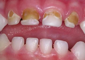 3. Zubní kaz v časném dětství 3.1 Zubní kaz Zubní kaz je chronický infekční multifaktoriální dynamický proces, který provází období demineralizace a remineralizace.