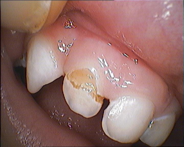 (hygienou, stravovacími návyky), aby nedocházelo k destrukcím dočasného chrupu, vlivem kariézních lézí. Tím ke vzniku ortodontických anomálií ve stálém chrupu.