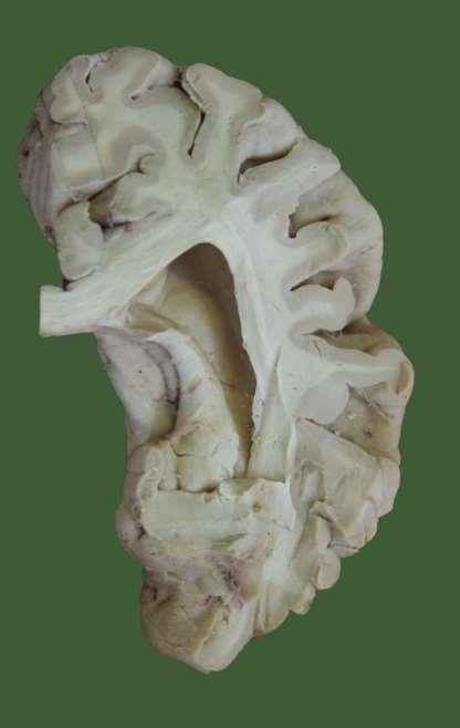 Hippokampální formace = archicortex = Cornu Ammonis +subiculum + g.