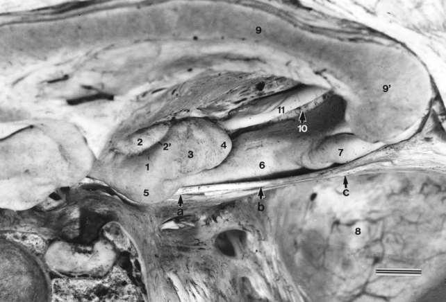 Poloha uncus a tentorium cerebelli CC SPel F F GD tentorium Fossa cranii posterior - cerebellum a kmen odstraněny 1 medial surface of uncus, 2 semilunar gyrus, 2 semianular sulcus, 3 uncinate gyrus,