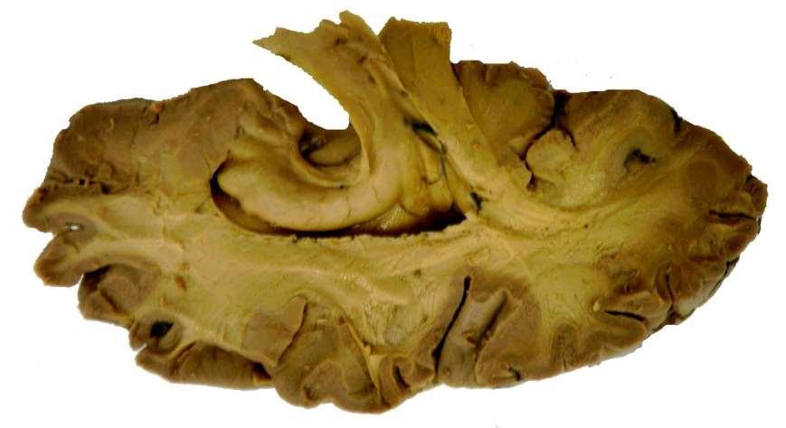 Hipocampus a amygdala