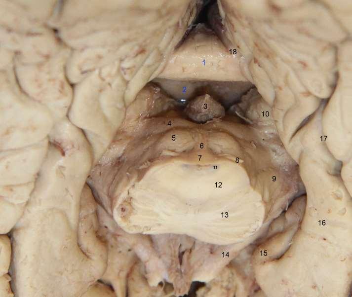 Pohled z ventrální strany na limbické struktury 1-corpus callosum 2- commissura fornicis 3-epiphysis 4-colliculus superior 5-colliculus inferior 6-frenulum veli medullaris sup 7-vellum medullare sup