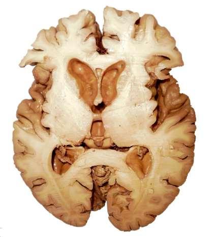 Horizontální řez v úrovni foramen