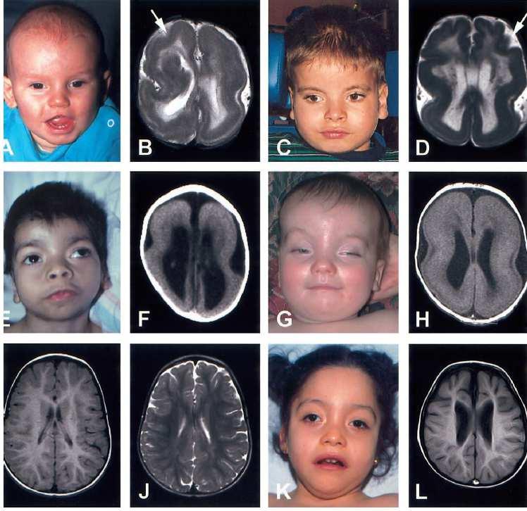 Syndrom Miller-Dieker Geny: LIS1(PAFAH1B1)