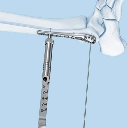 Implantace 5 Zavádění šroubů do těla dlahy 5a Zavádění konvenčních šroubů fixace 3,5 mm kortikálními šrouby Nástroje 310.250 Vrták B 2,5 mm, délka 110/85 mm, dvojbřitý, pro rychlospojku 310.
