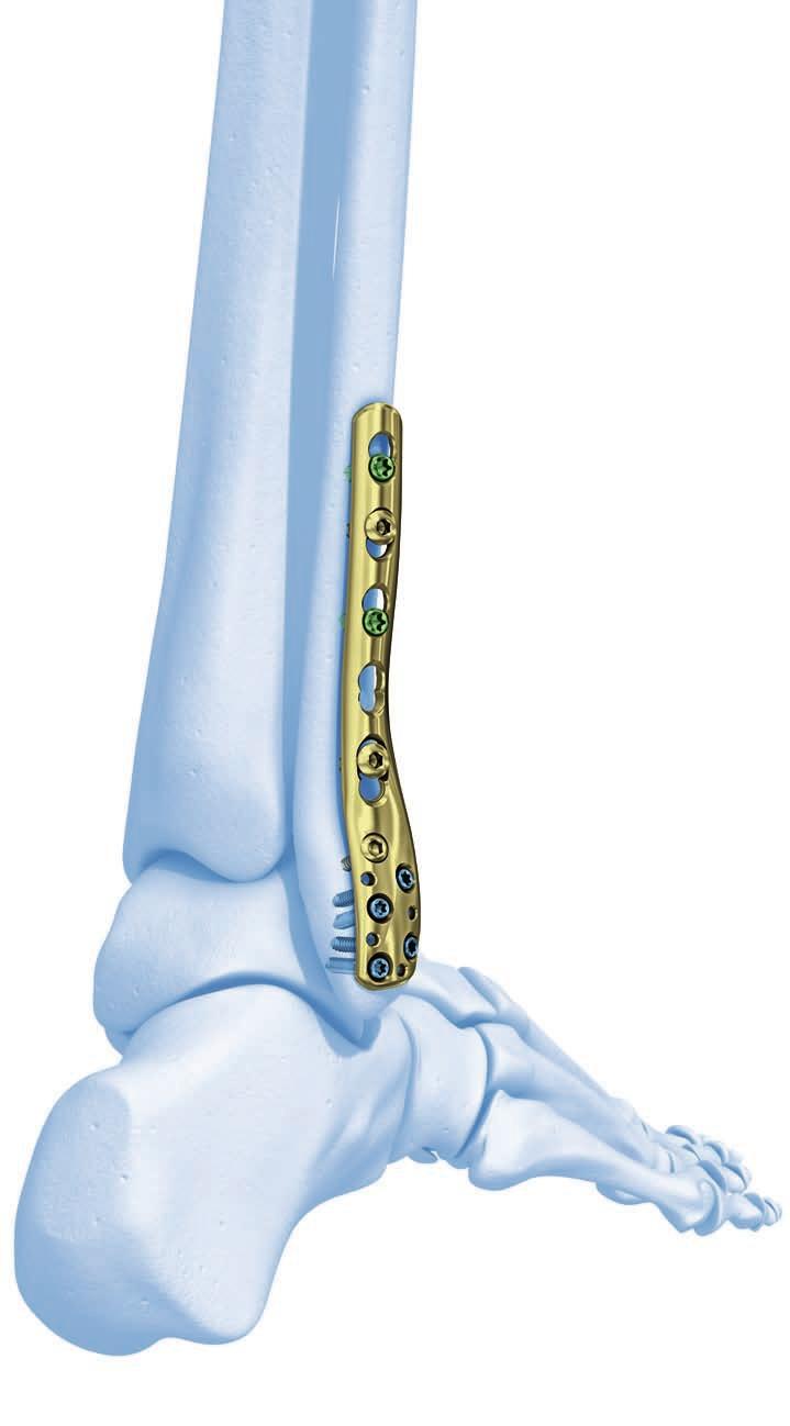 LCP dlahy na distální fibulu. Součást systému úhlově stabilních dlah LCP Synthes.