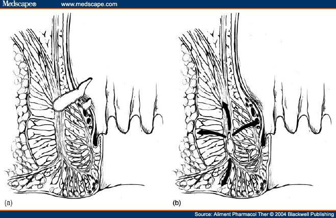 PERIANÁLNÍ CROHNOVA CHOROBA Etiologie perianální CD: 1) fistulace infikované +