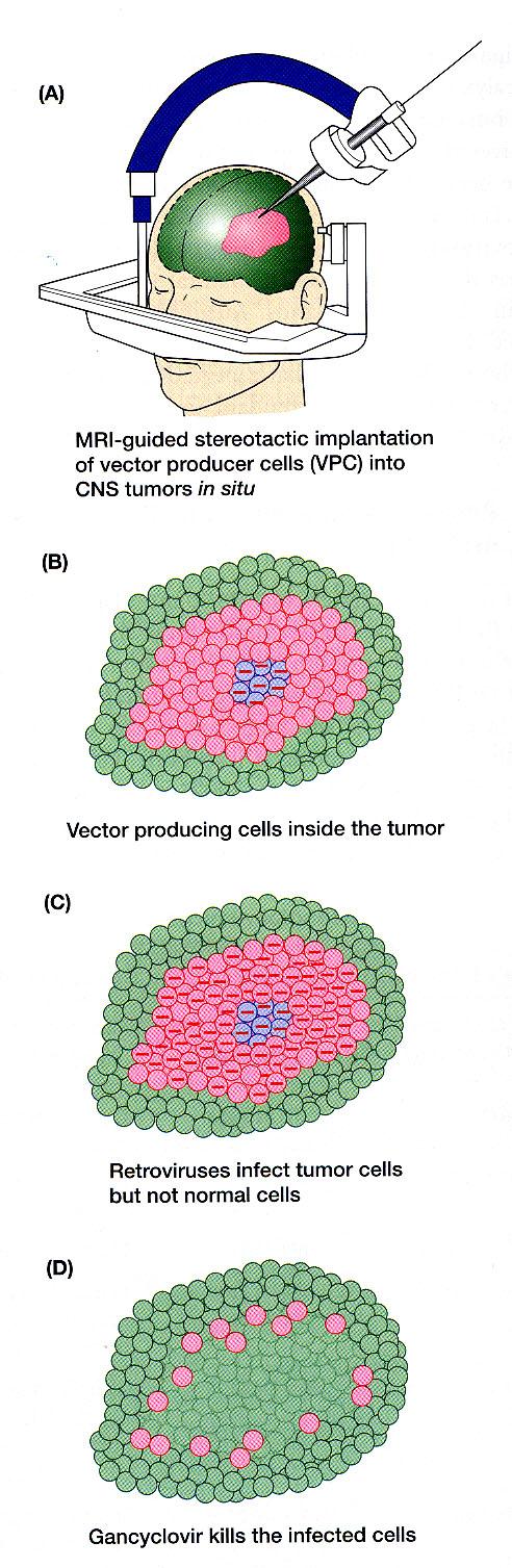 Genová terapie nádorů in vivo Do nádoru jsou injikovány buňky, do nichž byl in vitro vnesen retrovirový vektor, který obsahuje gen pro tymidinkinázu (TK).