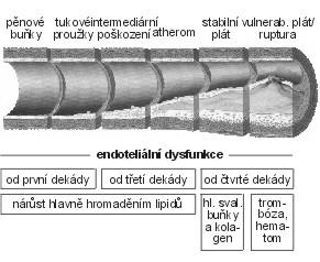 Obr. 2 Vývoj aterosklerózy (Stary, 1995; materiál "IMPPACT", BMS ČR)[1] 2.3.