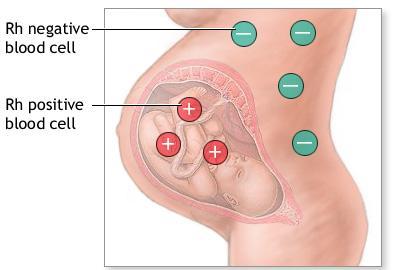 RH faktor Význam Rh při hemolytické nemoci novorozenců Protilátky Rh systému, zejména anti-d a anti-c jsou schopny způsobit hemolytickou