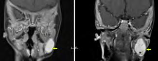 Provedená pediatrická a neurologická vyšetření, ultrazvuk břicha a krku, rentgen pasáž jícnem jsou negativní. Zvažována je psychosomatická příčina.