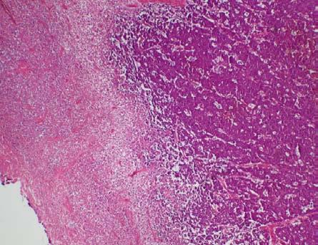 Obr. 2. Histologický preparát plasmablastický lymfom (vpravo), nekrotická povrchová zóna (vlevo), (Hematoxylin eosin, zvětšení 40x, foto Radim Žalud) Fig. 2. Plasmablastic lymphoma necrotic surface zone (Photo R.