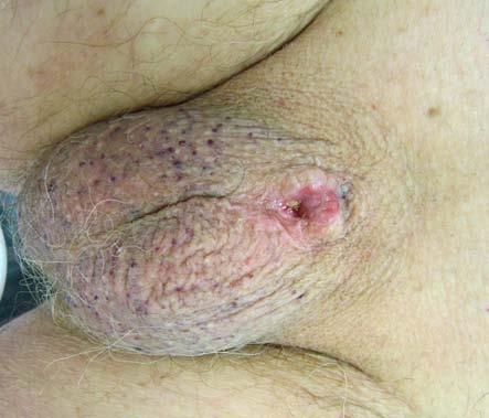 Obr. 4. Výsledný pooperační stav pahýl penisu, bez lokální recidivy lymfomu Fig. 4. Outcome after the radical surgery, no residual tumour or local relapse Plazmablastický lymfom představuje raritní subtyp DLBCL, poprvé popsaný v roce 1997.